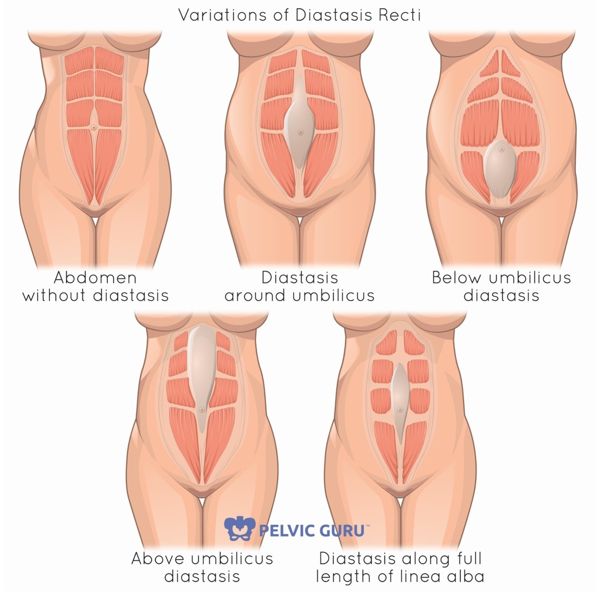 How to Improve Diastasis Recti After Baby